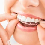 Invisalign Warszawa cena